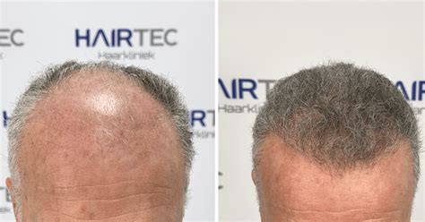 Documentaire: Het Proces Van Haartransplantatie