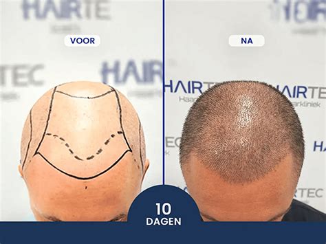 Haartransplantatie DHI: Een Gedetailleerd Procesoverzicht
