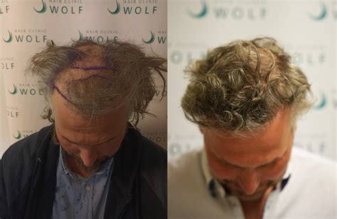Voorbereiding Op Een Haartransplantatie: Wat Je Moet Weten